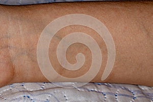 Human pulse with allergy spots