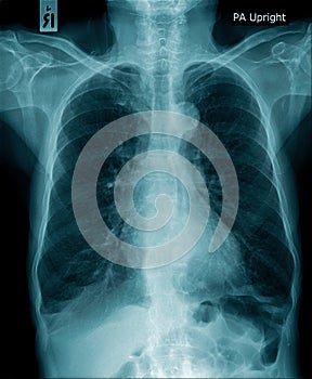 Human x-ray image, chest x-ray