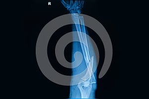 human x-rays showing fracture of radius bone