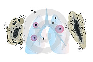 Human's lungs with fungi Aspergilloma Black mold colonies, allergenic black mildew spots, dark fungus colonies isolated