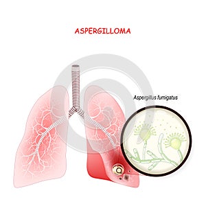 Human`s lungs with fungi. Close up of Aspergillus