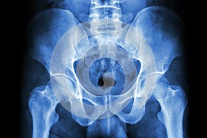 Human's pelvis and hip joints photo