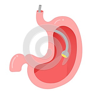 Human\'s Stomach, Stomach endoscopy. photo