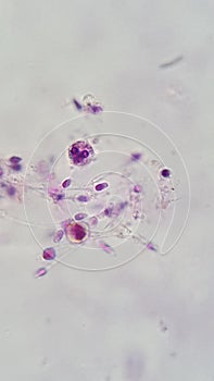 Human semen sample show Spermatozoon and white blood cell, posible semen infection photo