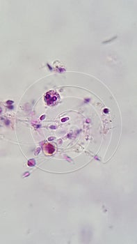 Human semen sample show Spermatozoon and white blood cell, posible semen infection