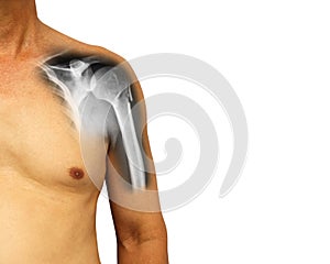 Human shoulder with x-ray show fracture at neck of humerus Arm bone . Isolated background . Blank area at right side photo
