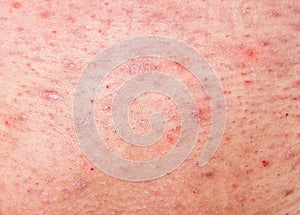 Human skin with acne