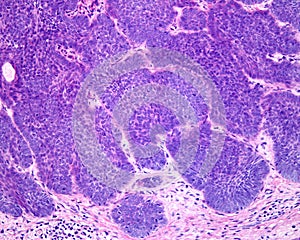 Human skin. Basal cell carcinoma