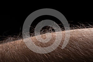 Human skin with hair on black background. Goose bumps