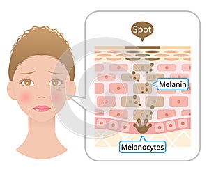Human skin layer with facial spot anatomy. Diagram of Melanin and melanocytes in human skin. beauty and skin care concept photo