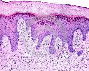 Human skin. Lichen planus