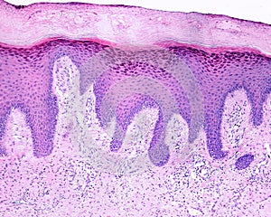 Human skin. Lichen planus photo