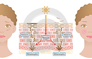 Human skin mechanism of melanin and facial dark spots. Infographic skin layer illustration. Beauty and skin care concept