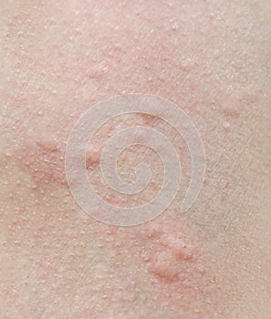 Human skin, presenting an allergic reaction photo