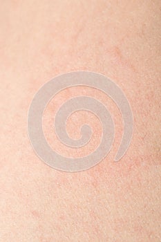 Human skin texture with black hairs on the skin for healthy back photo