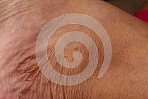 human skin texture. Flat wart on skin micro photo. close up photo