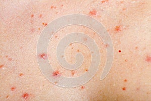 Human skinwith acne photo