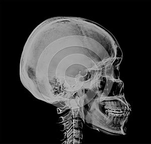 Human Skull Xray Negative Scan