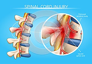 Human Spinal Cord Injury Anatomical Vector Scheme photo