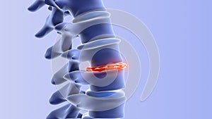 Human spine with degenerative disc