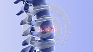 Human spine disc degeneration with osteophyte formation