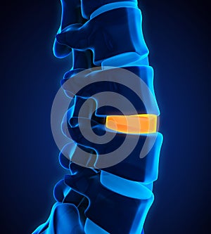 Human Spine Disc Degenerative