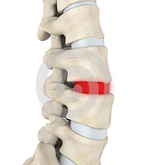 Human Spine Disc Degenerative