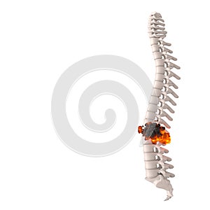 Human spine with disc herniation concept