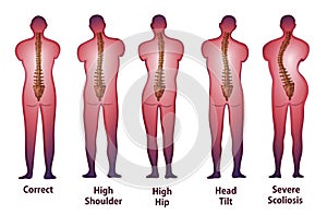 Human spine posture Back view