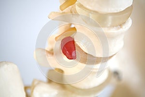 Human Spine showing a Ruptured Disk