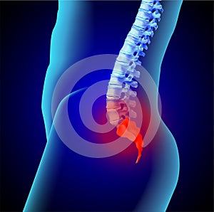 Human spine and tailbone. Inflammatory process.