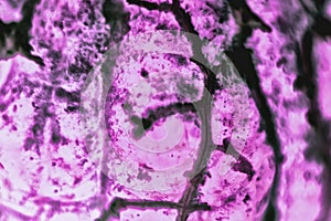 Human squamous cell carcinoma. Tissues affected by cancer cells under a microscope