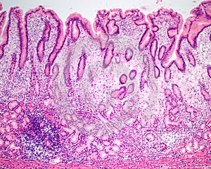 Human stomach. Chronic gastritis