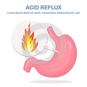 Human stomach. Gastroesophageal reflux disease. GERD, heartburn, gastric infographic. Acid moving up into the esophagus. Vector
