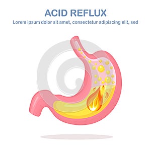 Human stomach. Gastroesophageal reflux disease. GERD, heartburn, gastric infographic. Acid moving up into the esophagus. Vector