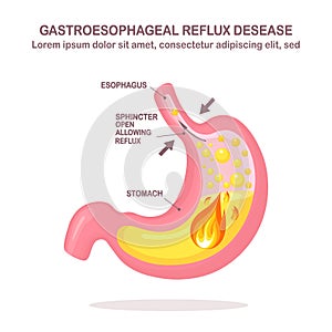 Human stomach. Gastroesophageal reflux disease. GERD, heartburn, gastric infographic. Acid moving up into the esophagus. Vector