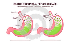 Human stomach. Gastroesophageal reflux disease. GERD, heartburn, gastric infographic. Acid moving up into the esophagus. Vector