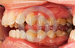 Human teeth