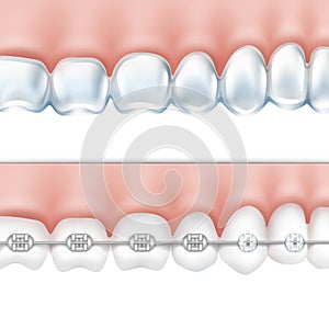 Human teeth with braces set