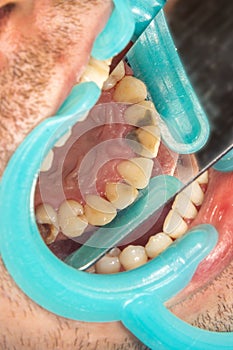 Human teeth with caries and cavity. Close-up macro in dental clinic. Treatment concept