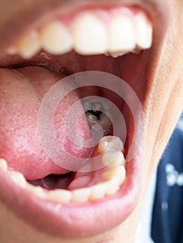 Human teeth with cavity needing treatment