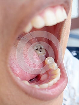 Human teeth with cavity needing treatment