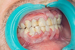 Human teeth closeup with dental plaque and inflammation of gingivitis. Concept of brushing teeth and poor hygiene