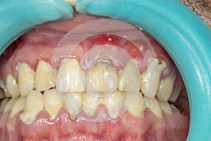Human teeth closeup with dental plaque and inflammation of gingivitis. Concept of brushing teeth and poor hygiene photo