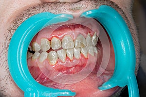 Human teeth closeup with dental plaque and inflammation of gingivitis. Concept of brushing teeth and poor hygiene