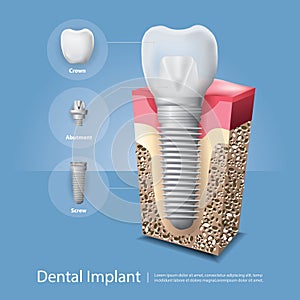 Human teeth and Dental implant