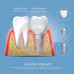 Human teeth and Dental implant