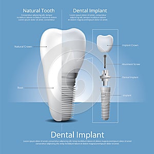 Human teeth and Dental implant