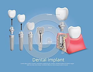 Human teeth and Dental implant