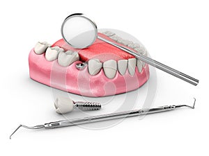 Human teeth and Dental implant. 3d illustration